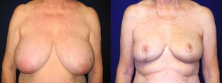 Frontal View - Breast Reconstruction