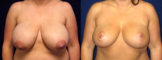 Frontal View - Breast Reduction