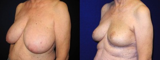 Left 3/4 View - Breast Reconstruction