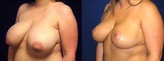 Left 3/4 View - Breast Reduction