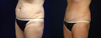 Left 3/4 View - Tummy Tuck After Pregnancy