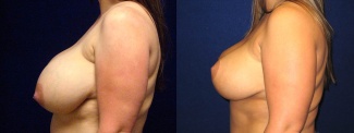 Left Profile View - Breast Reduction