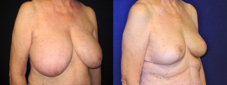 Right 3/4 View - Breast Reconstruction