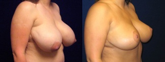 Right 3/4 View - Breast Reduction