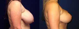 Right Profile View - Breast Reduction
