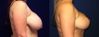 Right Profile View - Breast Reduction