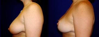 Left Profile View - Breast Lift