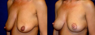 Left 3/4 View - Breast Lift After Pregnancy