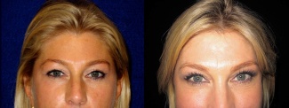 Fontal View - Upper Eyelid Surgery