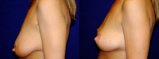 Left Profile View - Breast Lift After Pregnancy