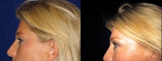 Left Profile View - Upper Eyelid Surgery