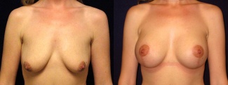 Frontal View - Breast Augmentation with Lift - Silicone Implants