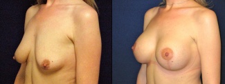 Left 3/4 View - Breast Augmentation with Lift - Silicone Implants