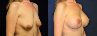 Right 3/4 View - Breast Augmentation - Silicone Implants