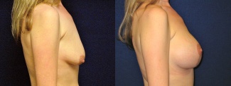 Right Profile View - Breast Augmentation - Silicone Implants