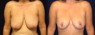 Frontal View - Breast Lift After Pregnancy