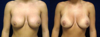 Frontal View - Breast Implant Revision - Silicone Implants