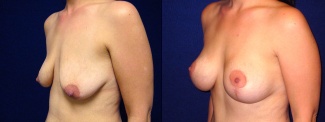 Left 3/4 View - Breast Augmentation with Lift After Pregnancy