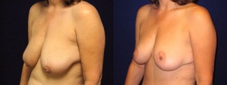 Left 3/4 View - Breast Lift After Pregnancy