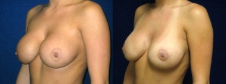 Left 3/4 View - Breast Implant Revision - Silicone Implants