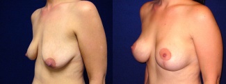 Left 3/4 View - Breast Augmentation with Lift After Pregnancy