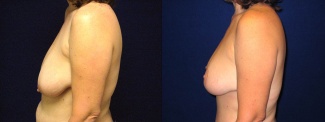 Left Profile View - Breast Lift After Pregnancy