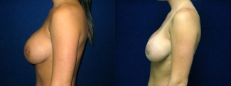 Left Profile View - Breast Implant Revision - Silicone Implants