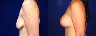 Left Profile View - Breast Augmentation with Lift After Pregnancy