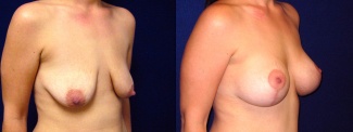 Right 3/4 View - Breast Augmentation with Lift After Pregnancy