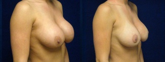 Right 3/4 View - Breast Implant Revision - Silicone Implants