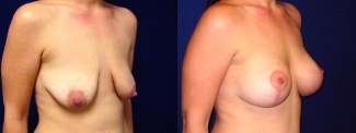 Right 3/4 View - Breast Augmentation with Lift After Pregnancy