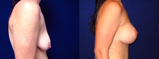 Right Profile View - Breast Augmentation with Lift After Pregnancy