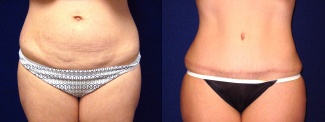 Frontal View - Tummy Tuck After Pregnancy