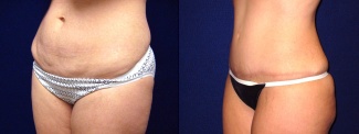 Left 3/4 View - Tummy Tuck After Pregnancy