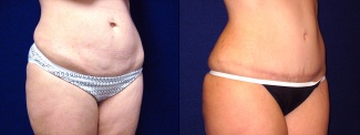 Right 3/4 View - Tummy Tuck After Pregnancy