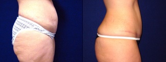 Right Profile View - Tummy Tuck After Pregnancy