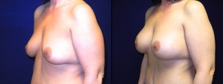Left 3/4 View - Breast Augmentation After Weight Loss