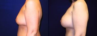 Left Profile View - Breast Augmentation After Weight Loss