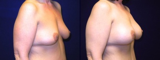 Right 3/4 View - Breast Augmentation After Weight Loss