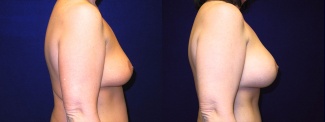 Right Profile View - Breast Augmentation After Weight Loss