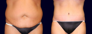 Frontal View - Tummy Tuck After Weight Loss