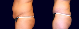 Left Profile View - Tummy Tuck After Weight Loss