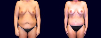Frontal View - Breast Augmentation & Tummy Tuck After Weight Loss