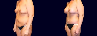 Left 3/4 View - Breast Augmentation & Tummy Tuck After Weight Loss