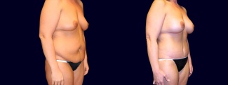 Right 3/4 View - Breast Augmentation & Tummy Tuck After Weight Loss