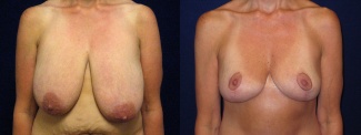Frontal View - Breast Lift Reduction