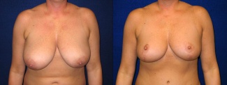 Frontal View - Breast Reduction After Pregnancy