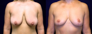 Frontal View - Breast Lift After Weight Loss