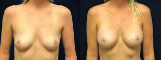 Frontal View - Breast Augmentation - Silicone Implants