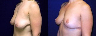 Left 3/4  View - Breast Lift After Weight Loss